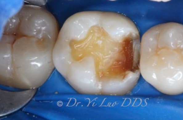 Molar Filling Before