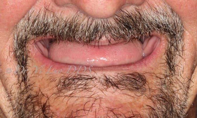 Upper Implant Overdenture and Lower Full Arch Fixed Implant Hybrid Prosthesis Before