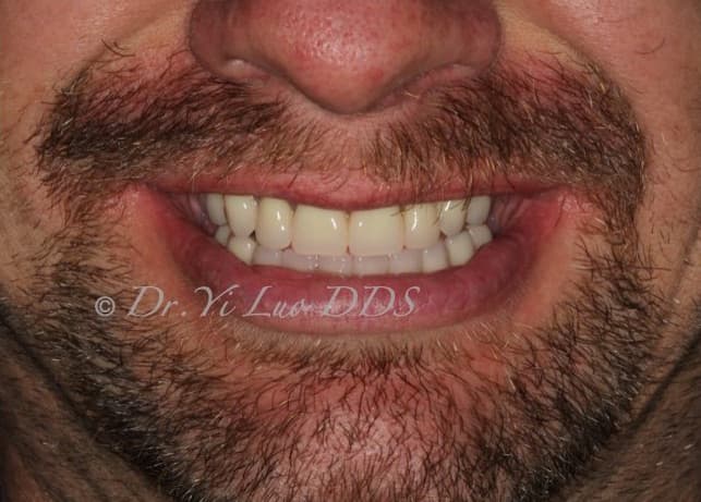 Upper Removable Partial Denture and Lower All-On-X Full Arch Fixed Implant Hybrid Prosthesis After