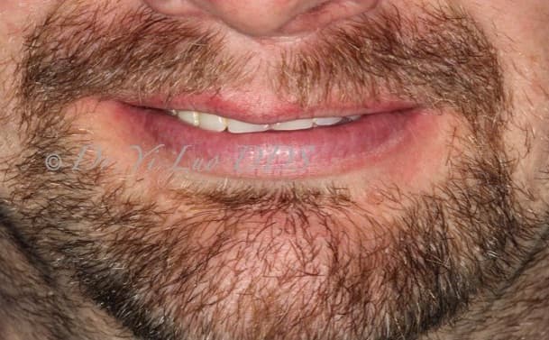 Upper Removable Partial Denture and Lower All-On-X Full Arch Fixed Implant Hybrid Prosthesis Before