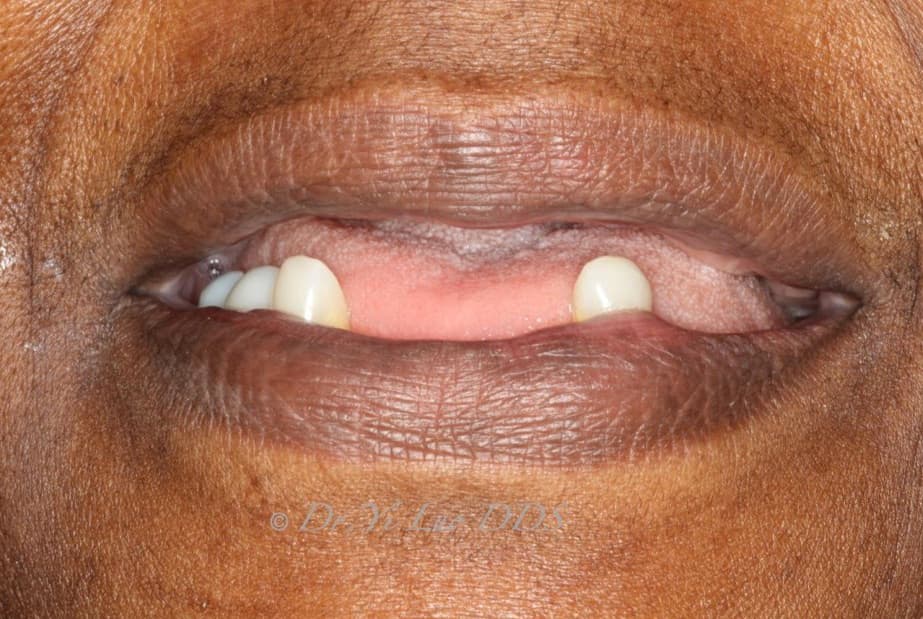 Upper Complete Denture and Lower Removable Partial Denture Before