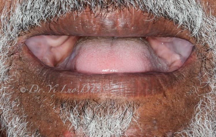 Upper and Lower Complete Dentures Before