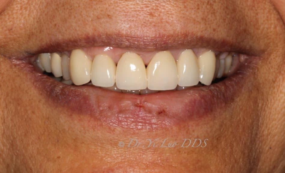 Upper Front Veneers After