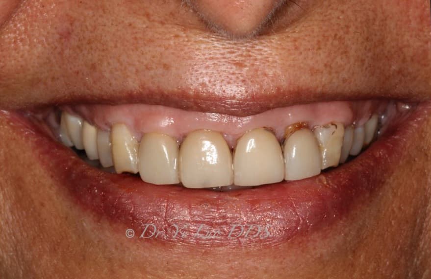 Upper Front Veneers Before
