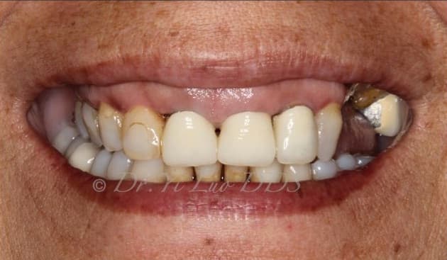 Upper Front Veneers and Crowns Before