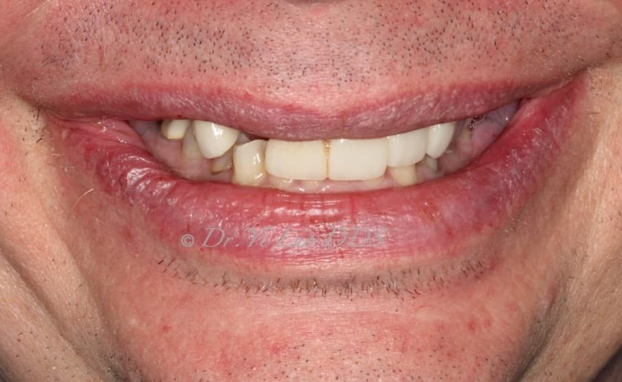 Single Implant Crown Before