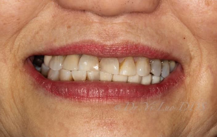 Implant Bridge After