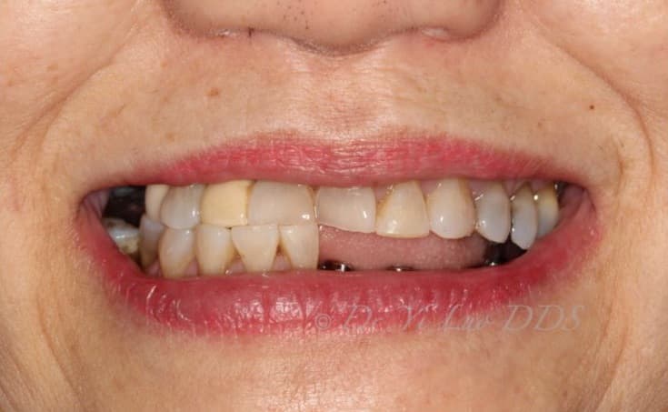 Implant Bridge Before