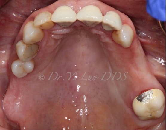 Implant Crown and Bridge Before
