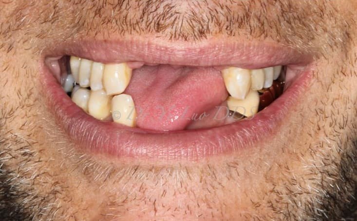 Upper and Lower Front Implant Bridge Before