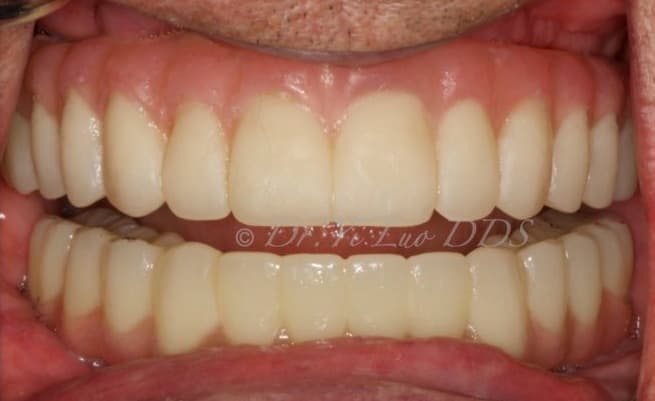 Upper and Lower All-On-X Full Arch Fixed Zirconia Implant Prostheses After